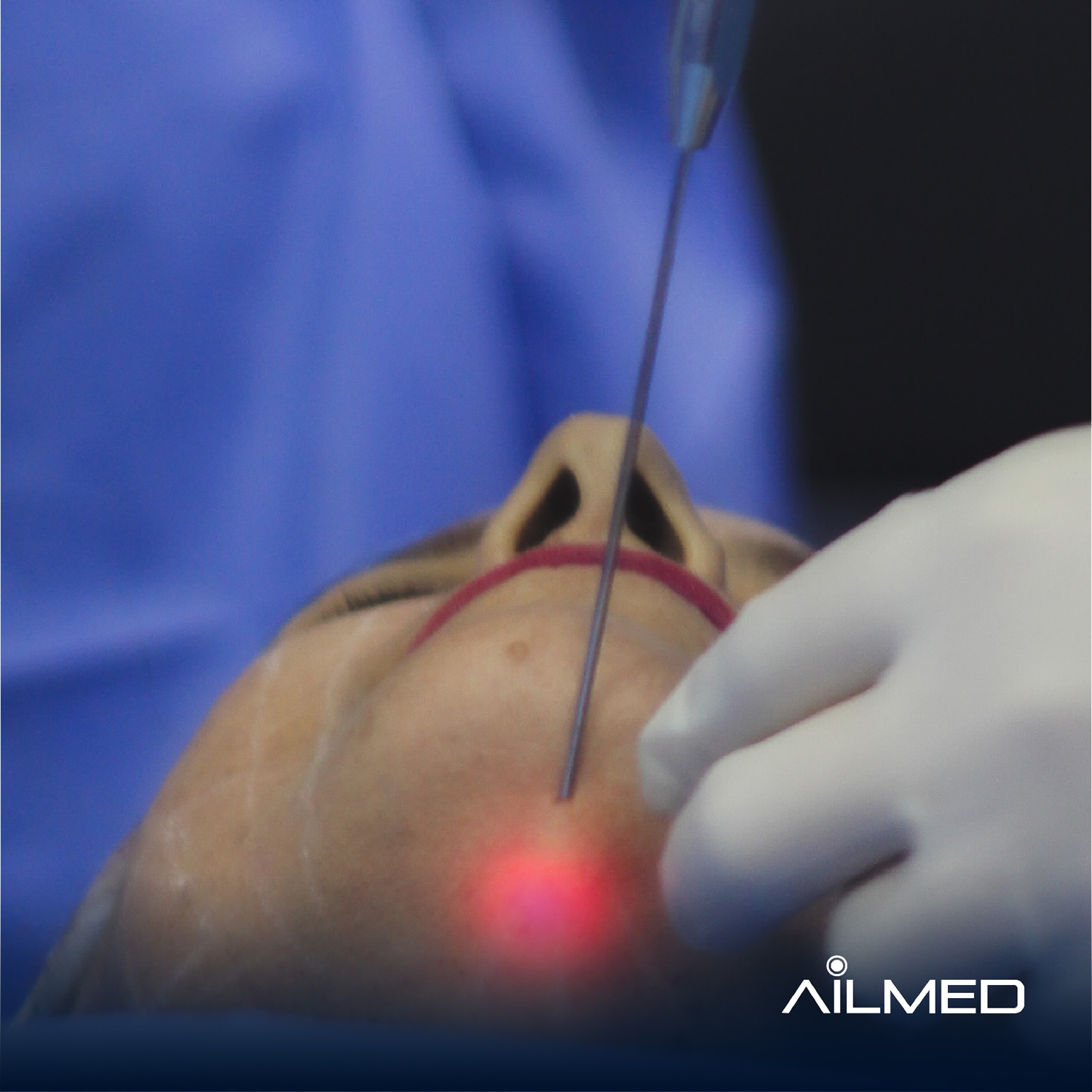 Curso de Certificación Internacional de Endoláser Facial
